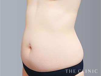 くびれの脂肪吸引の施術前の症例写真1（50歳/女性）