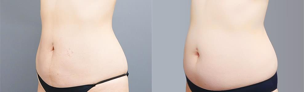 自然なくびれをデザインした脂肪吸引症例（50歳/女性）｜ザクリニック広島