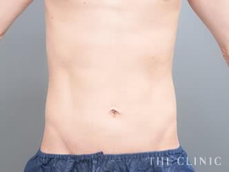 360脂肪吸引®の施術前の症例写真1（37歳/男性）
