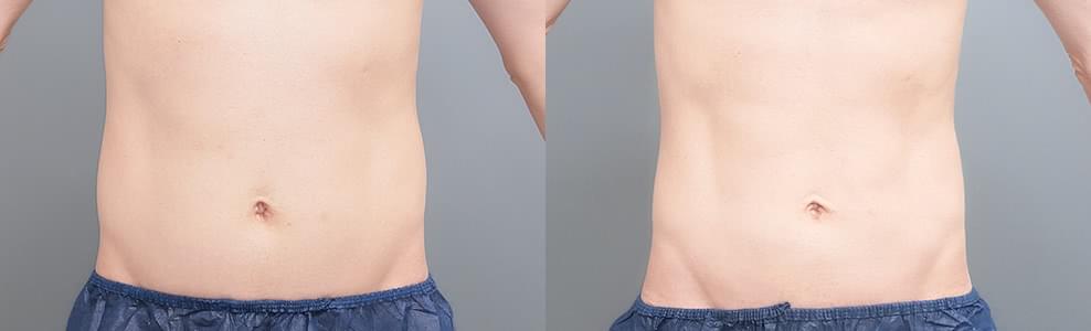 30代で気になり始めた下腹部を脂肪吸引でスッキリさせた男性の症例(37歳)｜ザクリニック広島