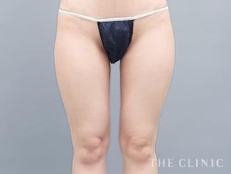 ベイザー脂肪吸引の施術後の症例写真2（30歳/女性）