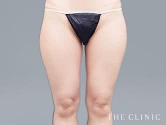 ベイザー脂肪吸引の施術前の症例写真1（30歳/女性）