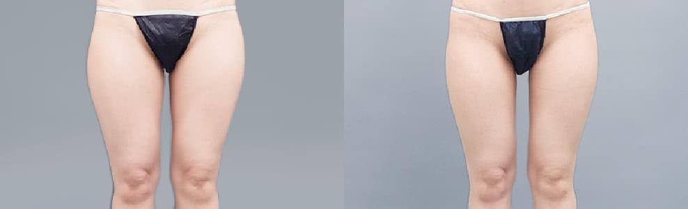 太ももの外張りを脂肪吸引で改善した女性の症例（30歳）｜ザクリニック広島院