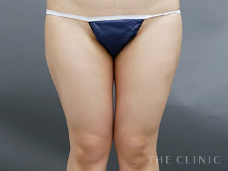 太もも脂肪吸引の施術前の症例写真1（26歳/女性）