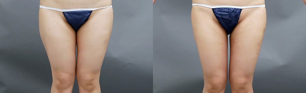 脂肪吸引「太もも」の症例写真（26歳/女性）｜ザクリニック広島院