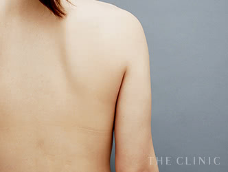 二の腕・肩の脂肪吸引の施術後の症例写真1（30歳/女性）