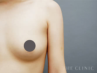 二の腕・肩の脂肪吸引の施術後の症例写真2（30歳/女性）