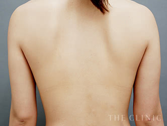 二の腕・肩の脂肪吸引の施術後の症例写真4（30歳/女性）