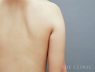 二の腕・肩の脂肪吸引の施術前の症例写真1（30歳/女性）