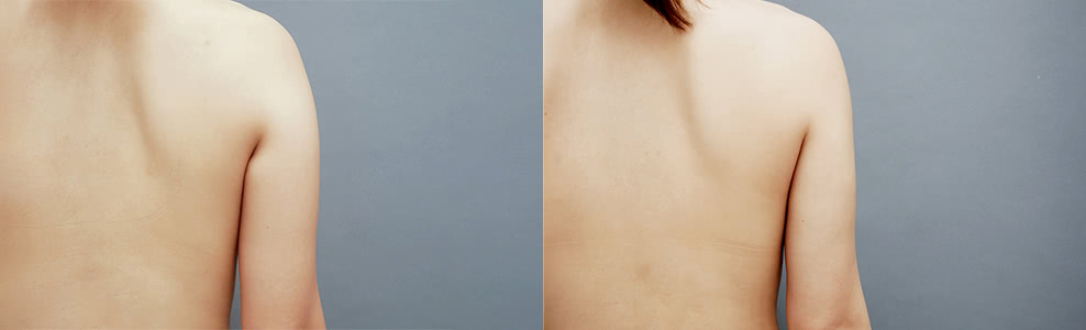脂肪吸引「二の腕・肩」の症例写真（30歳/女性）｜ザクリニック広島院
