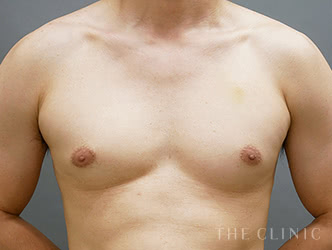 女性化乳房の施術前の症例写真(38歳/男性)