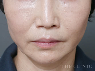 顔の脂肪吸引の施術後の症例写真1（57歳/女性）