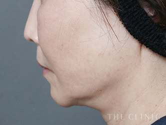 顔の脂肪吸引の施術後の症例写真2（57歳/女性）
