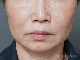 顔の脂肪吸引の施術前の症例写真1（57歳/女性）