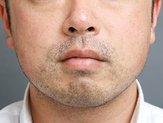 顔の脂肪吸引の施術後の症例写真1（34歳/男性）