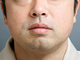 顔の脂肪吸引の施術前の症例写真1（34歳/男性）