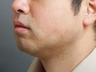 顔の脂肪吸引の施術前の症例写真1（34歳/男性）
