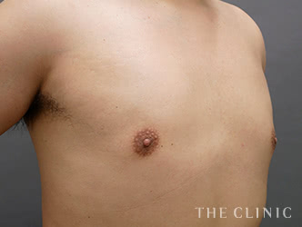 胸部の脂肪吸引の施術後の症例写真1（34歳/男性）