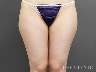 太ももの脂肪吸引の施術前の症例写真1（27歳/女性）
