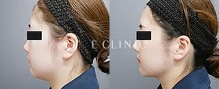 ベイザー脂肪吸引（27歳／女性）