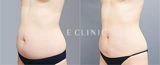 くびれ脂肪吸引（ベイザー脂肪吸引）（50歳／女性）