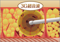 ベイザの脂肪吸引の超音波照射