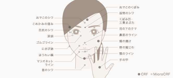 おでこのシワ おでこのくぼみ こめかみのくぼみ 眉間のシワ 目尻のシワ くぼみ目・三重まぶた 涙袋 目の下のクマ ゴルゴライン 鼻筋のライン にきび跡 頬の痩け ほうれい線 唇の縦じわ マリオネットライン 顎のライン 首のシワ 手の甲 | MicroCRF / CRF