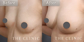 コンデンスリッチ豊胸の症例写真