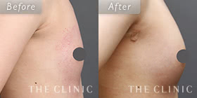 コンデンスビブラ豊胸の症例写真