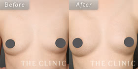 コンデンスリッチ豊胸の症例写真