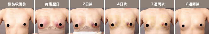 脂肪吸引前 施術翌日 ２日後 ４日後 １週間後 2週間後