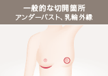 一般的な切開箇所 アンダーバスト、乳輪外縁