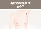 当院の切開箇所 脇の下