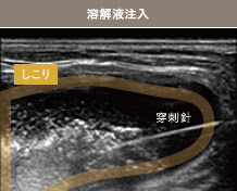 溶解液注入