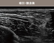 吸引・除去後