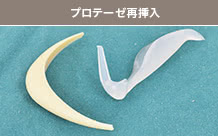 プロテーゼ再挿入