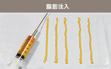 脂肪注入
