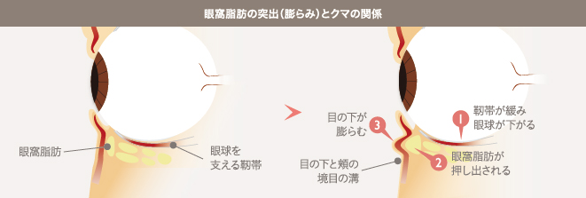 眼窩脂肪の突出(膨らみ)とクマの関係