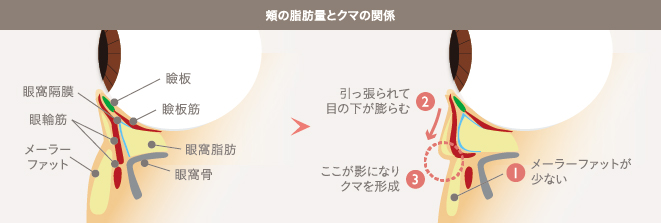 頬の脂肪量とクマの関係