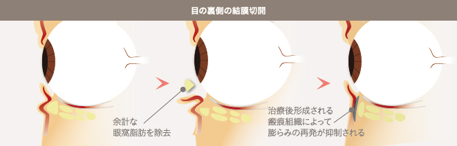 目の裏側の結膜切開
