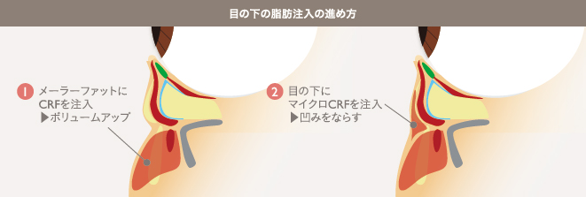 目の下の脂肪注入の進め方