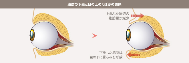 脂肪の下垂と目の上のくぼみの関係