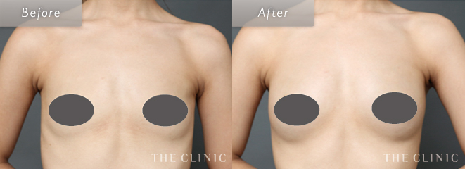 乳房拡張器（ビブラ）を併用した脂肪注入豊胸（コンデンスリッチ豊胸）の症例写真１