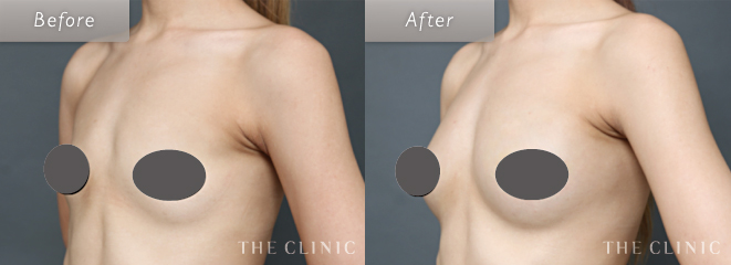 乳房拡張器（ビブラ）を併用した脂肪注入豊胸（コンデンスリッチ豊胸）の症例写真２