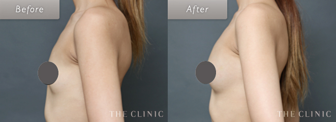 乳房拡張器（ビブラ）を併用した脂肪注入豊胸（コンデンスリッチ豊胸）の症例写真３