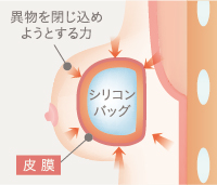 バッグ周辺に付着した繊維組織が厚みを増し、硬化した状態。バッグが強く締め付けられるため、劣化が加速する。