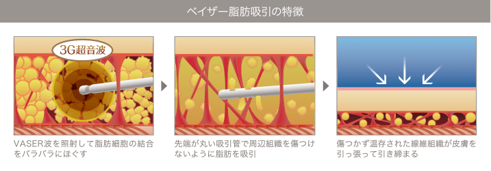 皮膚が引き締まる理由：温存された繊維組織が皮膚を引き締める