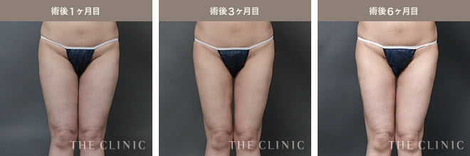 術後1ヶ月目 / 術後3ヶ月目 / 術後6ヶ月目