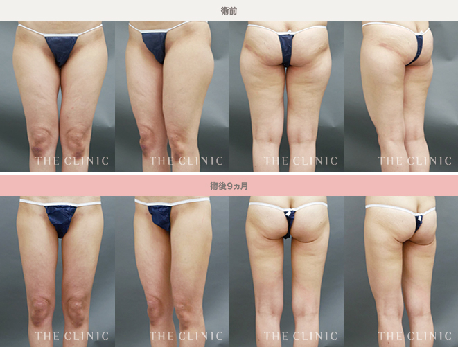 40代女性の太ももの脂肪吸引の術前／術後画像