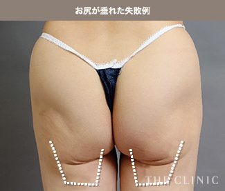 脂肪吸引後にお尻が垂れた失敗例